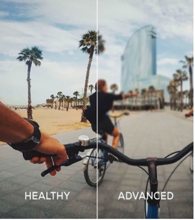 A side by side photo of an individual riding a bike with healthy vision and the other side with myopia.